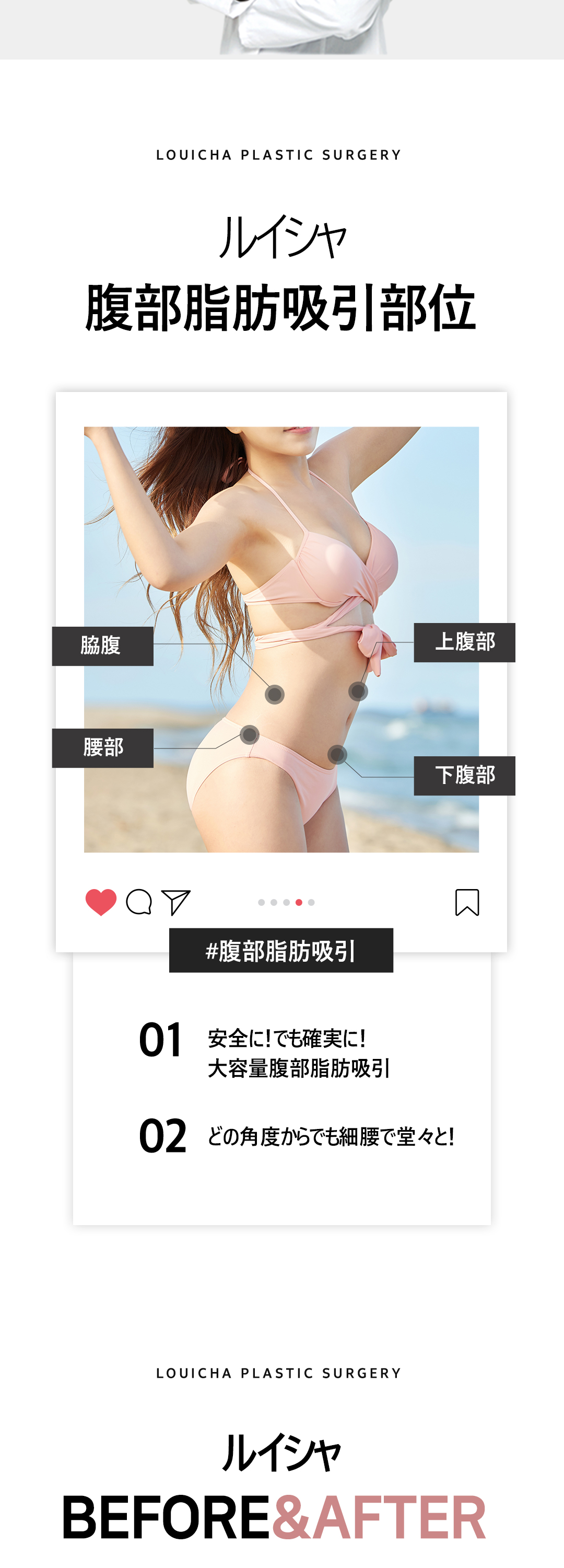 Hút mỡ bụng Louise Clinic Gangnam Hàn Quốc | Hút mỡ nguyên chất hướng đến body line lý tưởng | Hỗ trợ dung lượng lớn