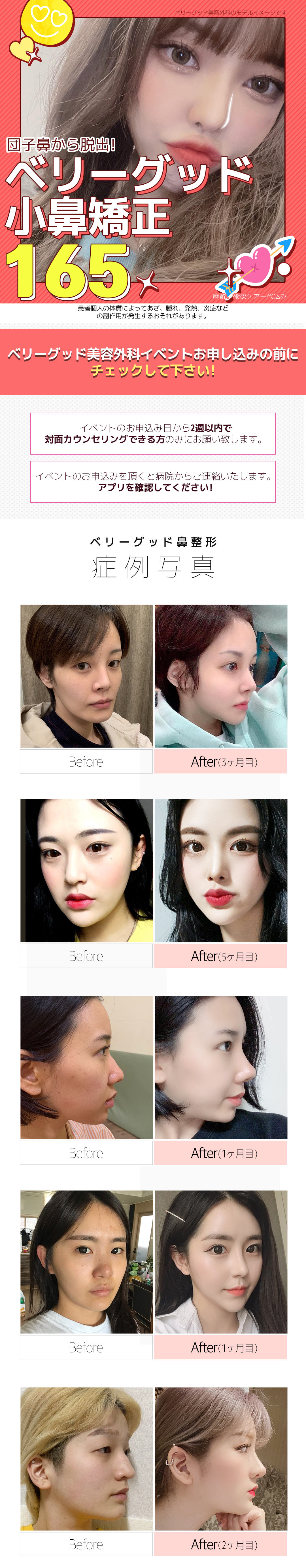 Hướng tới cải thiện mũi tròn với thu nhỏ cánh mũi | Hỗ trợ phân tích chính xác 3D-CT | Berry Good Phẫu thuật Thẩm mỹ ga Gangnam