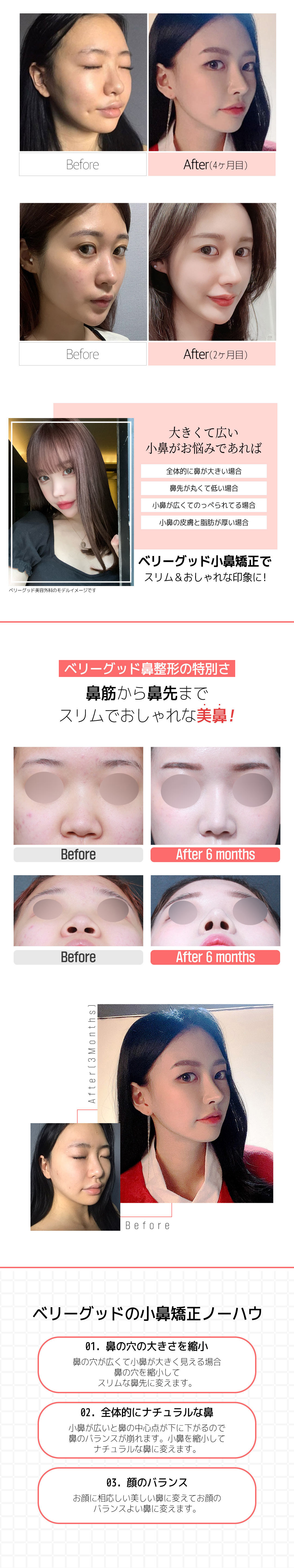 Hướng tới cải thiện mũi tròn với thu nhỏ cánh mũi | Hỗ trợ phân tích chính xác 3D-CT | Berry Good Phẫu thuật Thẩm mỹ ga Gangnam