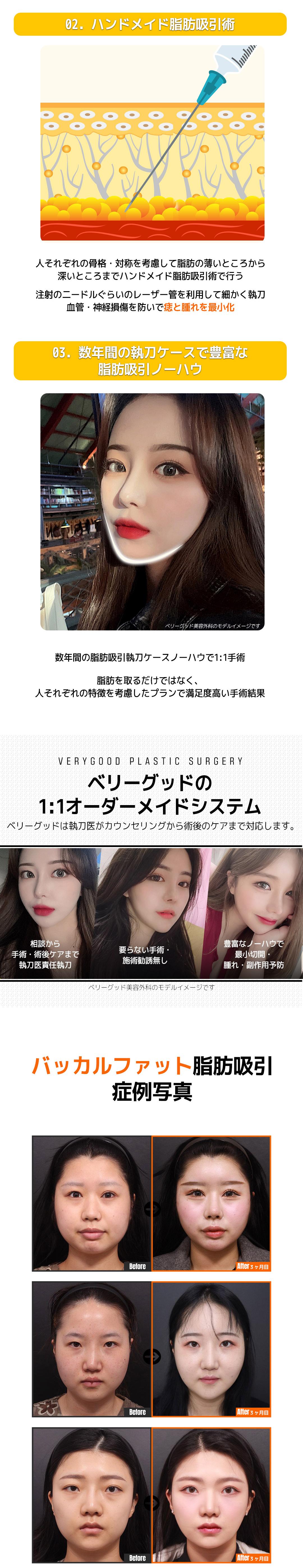 Loại bỏ mỡ Buccal tạo mặt nhỏ | Điều trị tùy chỉnh 1:1 bởi bác sĩ chuyên gia | Very Good Gangnam Hàn Quốc