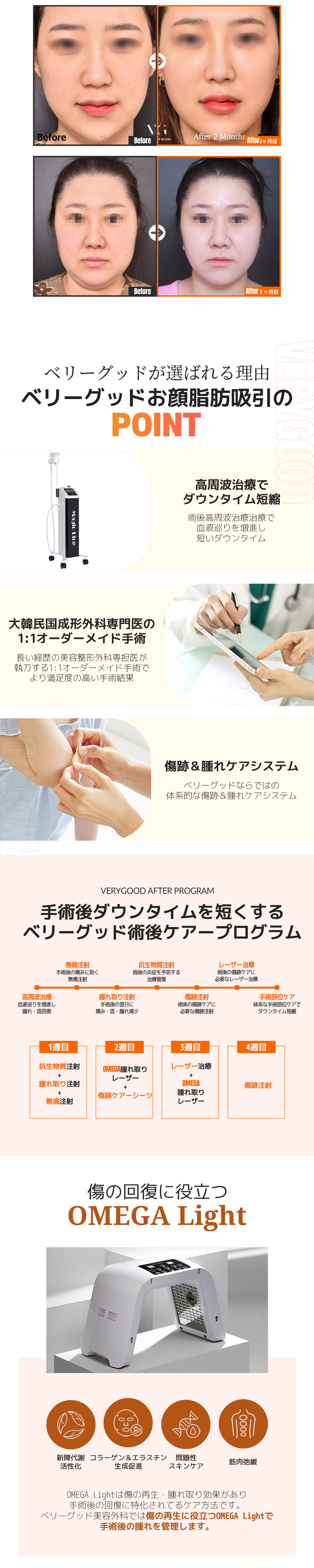 Loại bỏ mỡ Buccal tạo mặt nhỏ | Điều trị tùy chỉnh 1:1 bởi bác sĩ chuyên gia | Very Good Gangnam Hàn Quốc