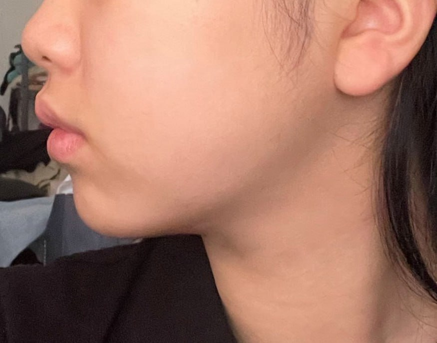 Loại bỏ mỡ Buccal tạo mặt nhỏ | Điều trị tùy chỉnh 1:1 bởi bác sĩ chuyên gia | Very Good Gangnam Hàn Quốc