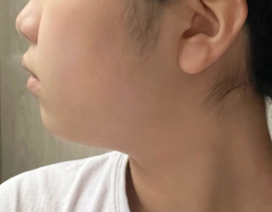 Loại bỏ mỡ Buccal tạo mặt nhỏ | Điều trị tùy chỉnh 1:1 bởi bác sĩ chuyên gia | Very Good Gangnam Hàn Quốc