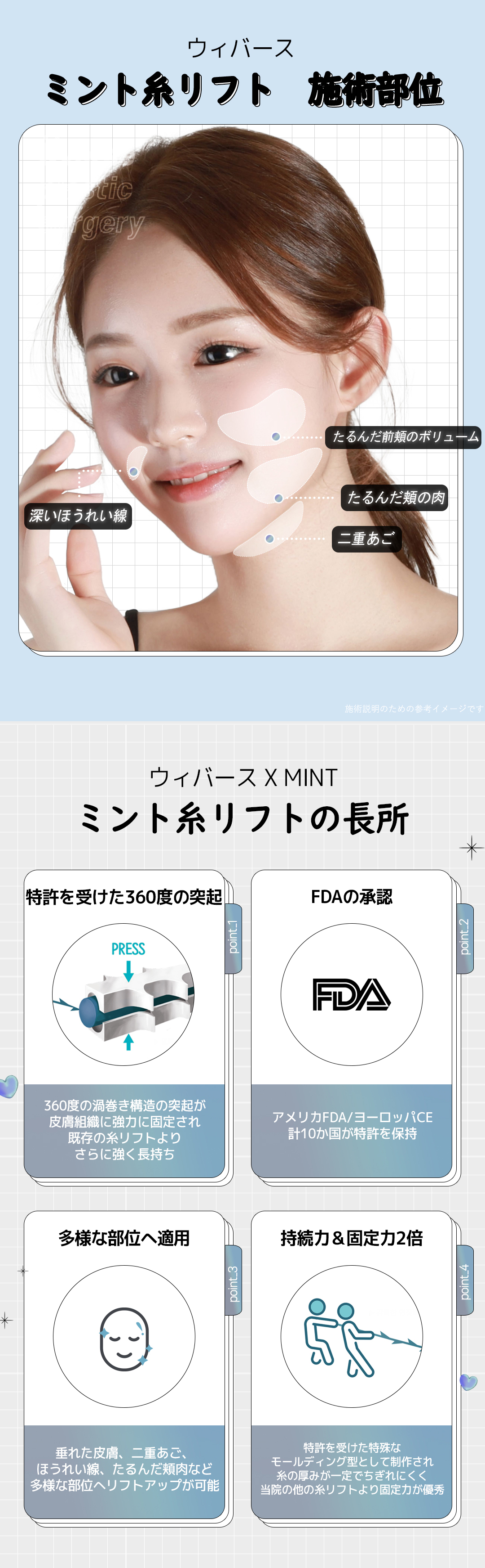 Chỉ Mint Lift | Chỉ gai 360 độ FDA cải thiện chảy xệ | Wiverse Clinic Gangnam