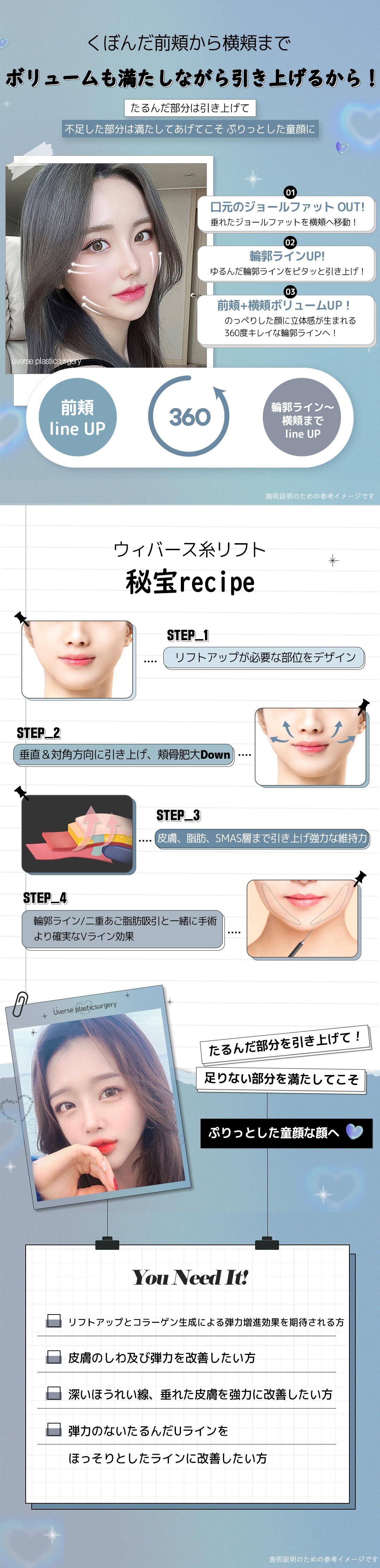 Chỉ Mint Lift | Chỉ gai 360 độ FDA cải thiện chảy xệ | Wiverse Clinic Gangnam