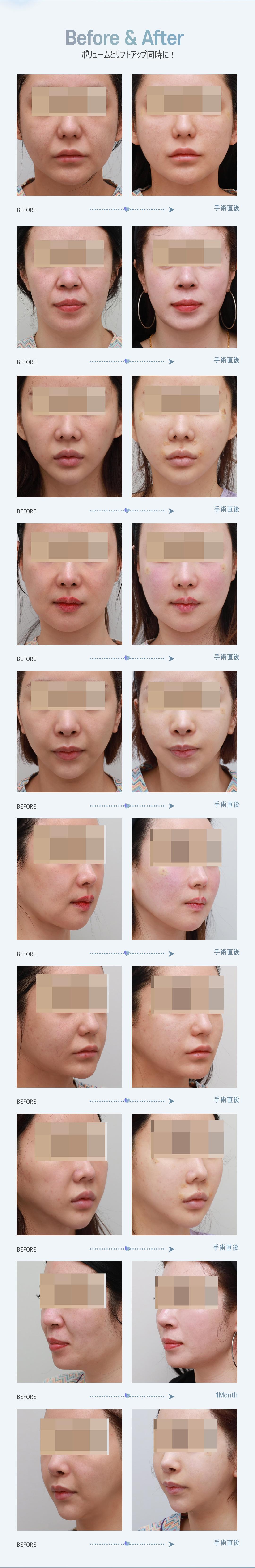 Chỉ Mint Lift | Chỉ gai 360 độ FDA cải thiện chảy xệ | Wiverse Clinic Gangnam