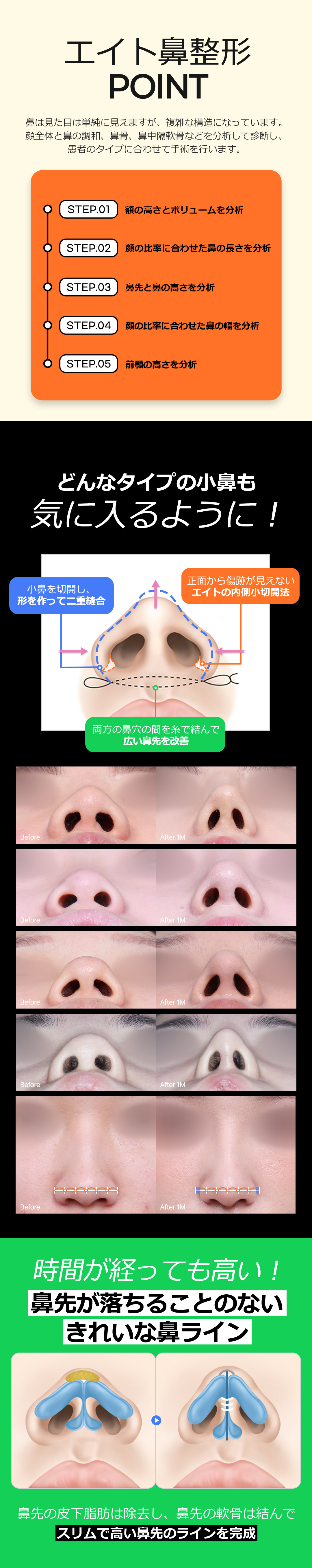 Nâng mũi Eight Phẫu thuật Thẩm mỹ Hàn Quốc (sống mũi + đầu mũi) Thủ thuật hướng tới cải thiện đường E-line xem xét cân bằng khuôn mặt | Cách ga Apgujeong 5 phút đi bộ
