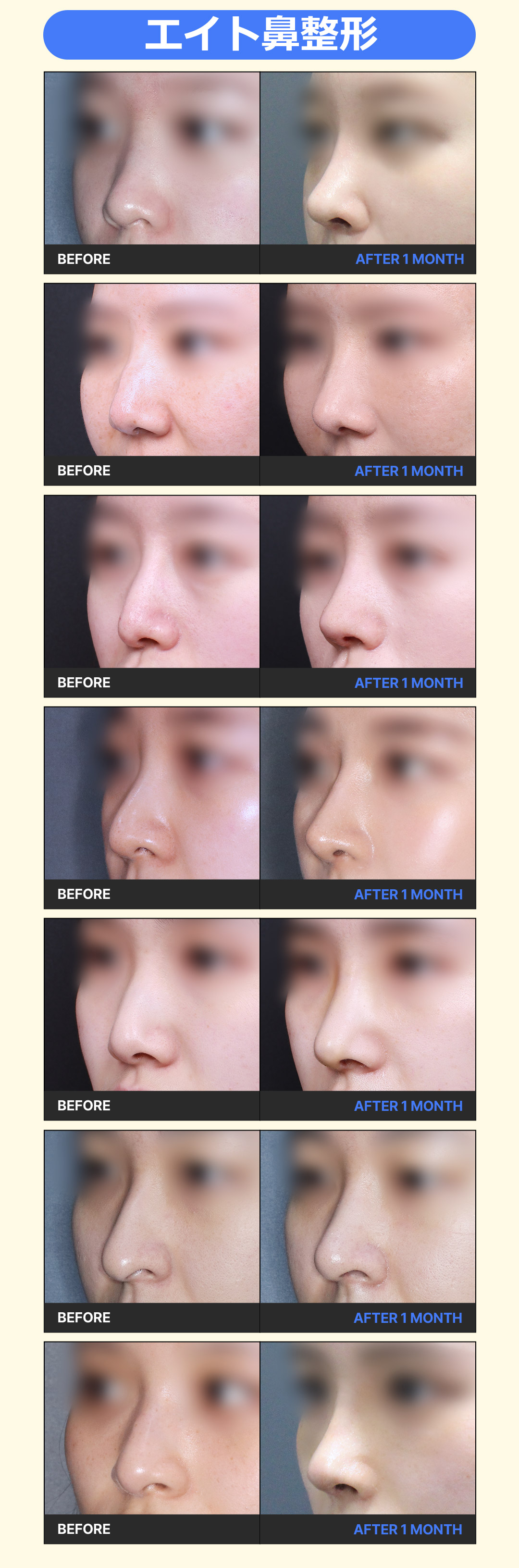 Nâng mũi Eight Phẫu thuật Thẩm mỹ Hàn Quốc (sống mũi + đầu mũi) Thủ thuật hướng tới cải thiện đường E-line xem xét cân bằng khuôn mặt | Cách ga Apgujeong 5 phút đi bộ