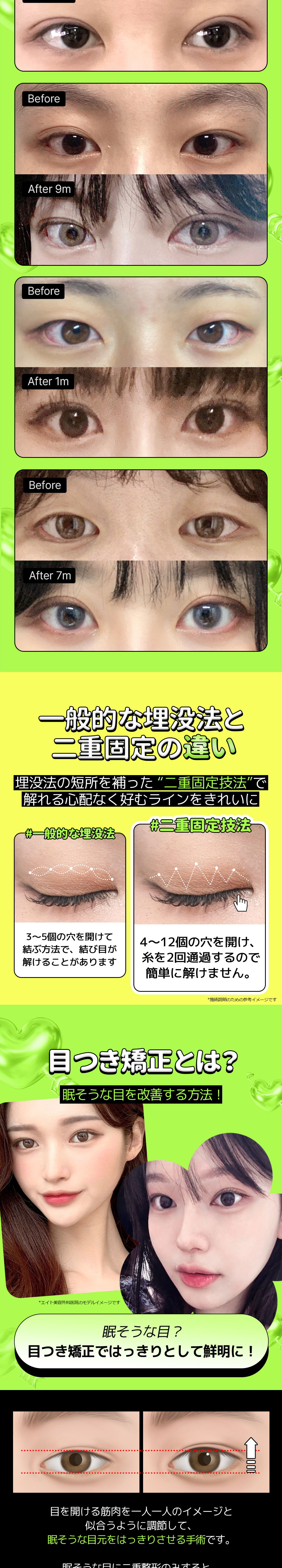 Bấm mí đôi Eight Thẩm mỹ Hàn Quốc | Thủ thuật hướng tới độ bền với kỹ thuật cố định mí đôi độc quyền | Cách ga Apgujeong 5 phút đi bộ