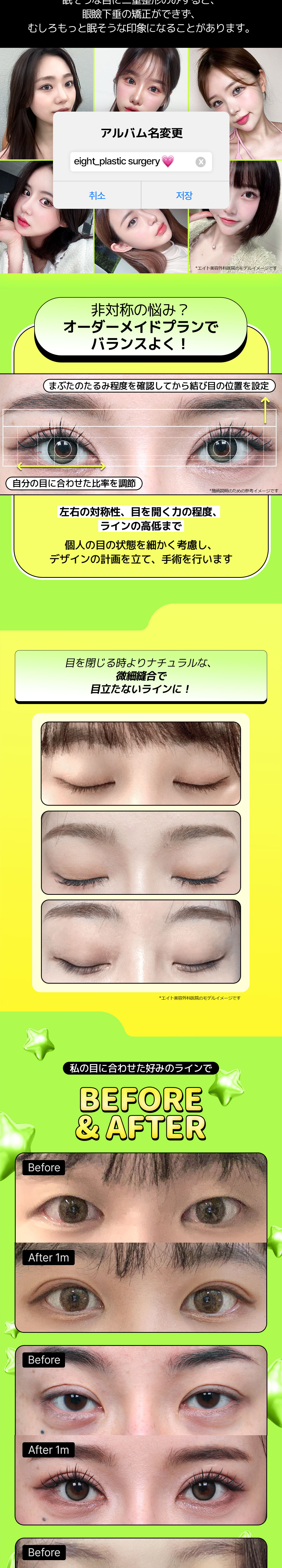 Bấm mí đôi Eight Thẩm mỹ Hàn Quốc | Thủ thuật hướng tới độ bền với kỹ thuật cố định mí đôi độc quyền | Cách ga Apgujeong 5 phút đi bộ