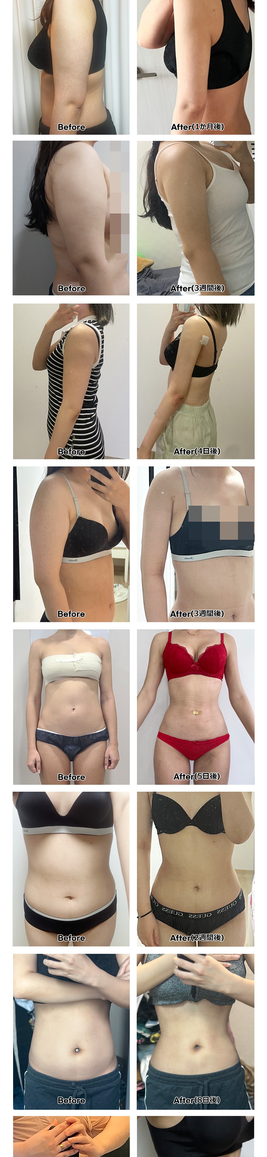 Hút mỡ bắp tay, bụng | Nhằm đường nét cơ thể lý tưởng với phân tích InBody | Fitting Clinic ga Sinsa, Seoul