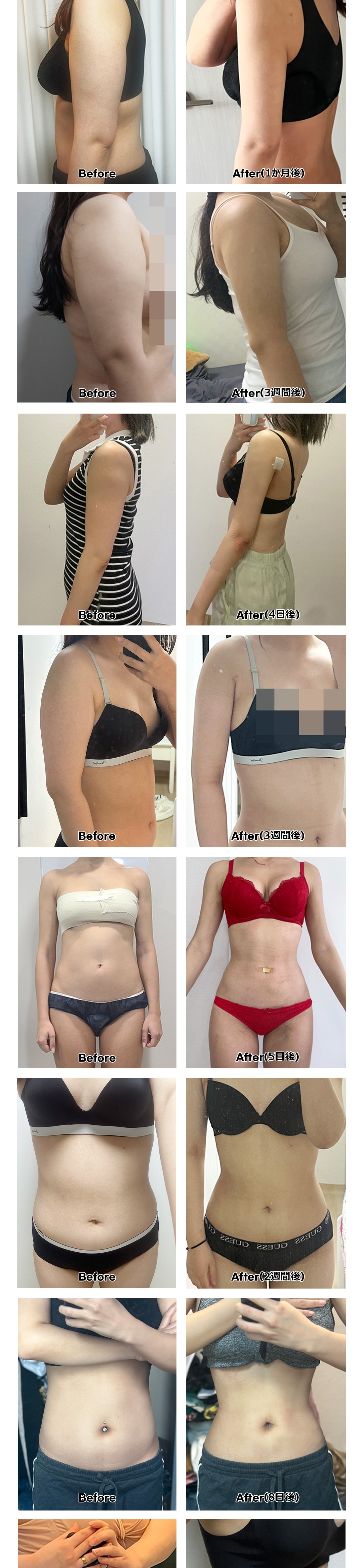 Hút mỡ dung lượng lớn tại Fitting Clinic | Nhằm đường nét cơ thể bằng phân tích InBody x loại bỏ mỡ sâu | Ga Sinsa, Seoul