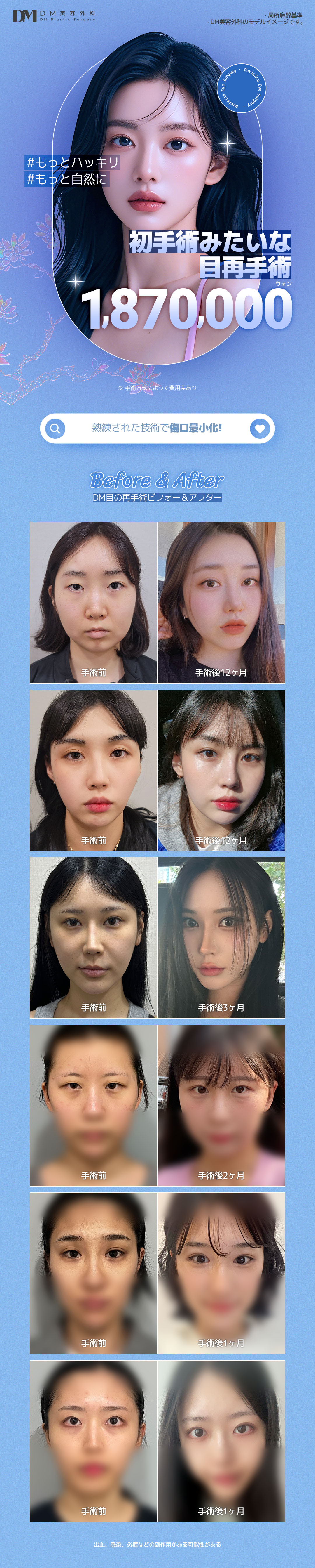 Phẫu thuật lại mắt | DM Thẩm mỹ Apgujeong | Hướng tới mí đôi lý tưởng với thủ thuật đặt hàng riêng 1:1【Bác sĩ chuyên khoa hơn 15 năm kinh nghiệm】