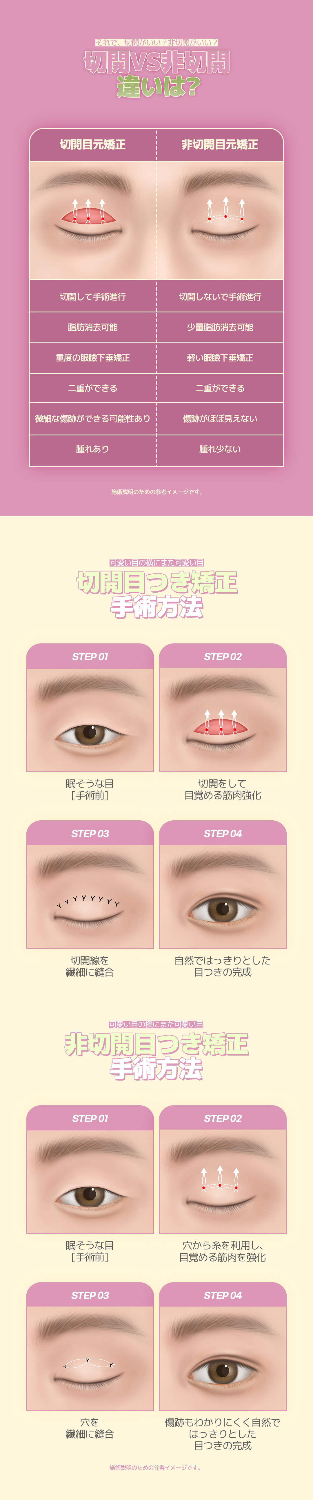 Hướng tới đôi mắt có ấn tượng sáng với Chỉnh ánh mắt (Cải thiện sụp mí) | Có thể chọn cắt・không cắt | Phòng khám DM Thẩm mỹ