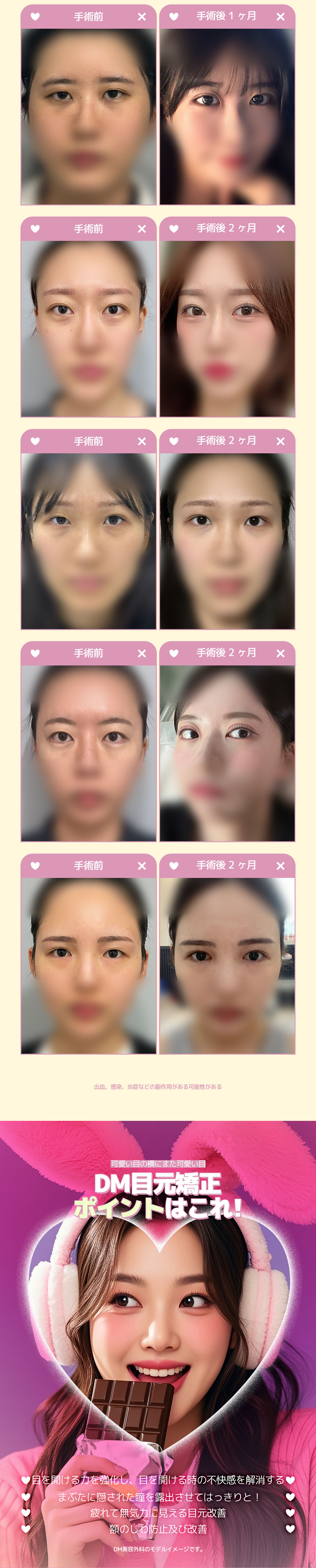 Hướng tới đôi mắt có ấn tượng sáng với Chỉnh ánh mắt (Cải thiện sụp mí) | Có thể chọn cắt・không cắt | Phòng khám DM Thẩm mỹ