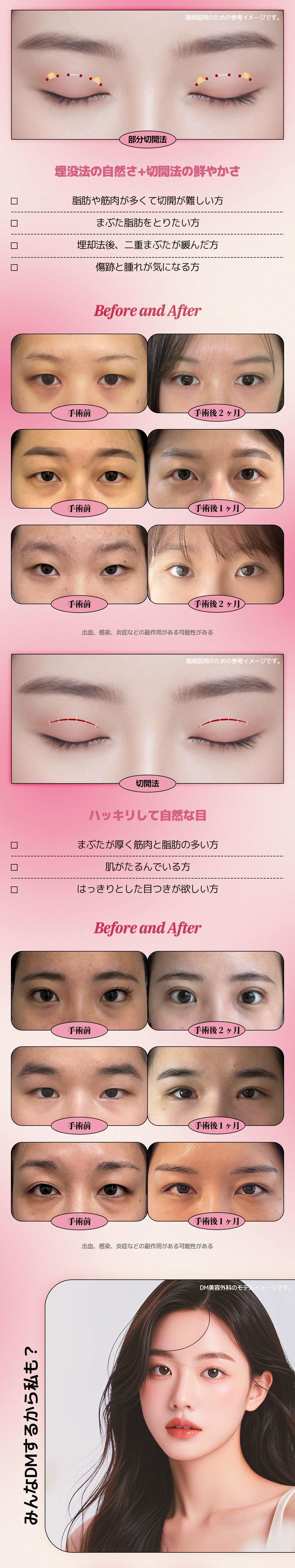 【Phẫu thuật mí đôi Hàn Quốc】Bấm mí・Cắt mí DM Thẩm mỹ | Phẫu thuật mí đôi đặt hàng riêng do viện trưởng đại diện thực hiện | Cách ga Apgujeong 3 phút đi bộ