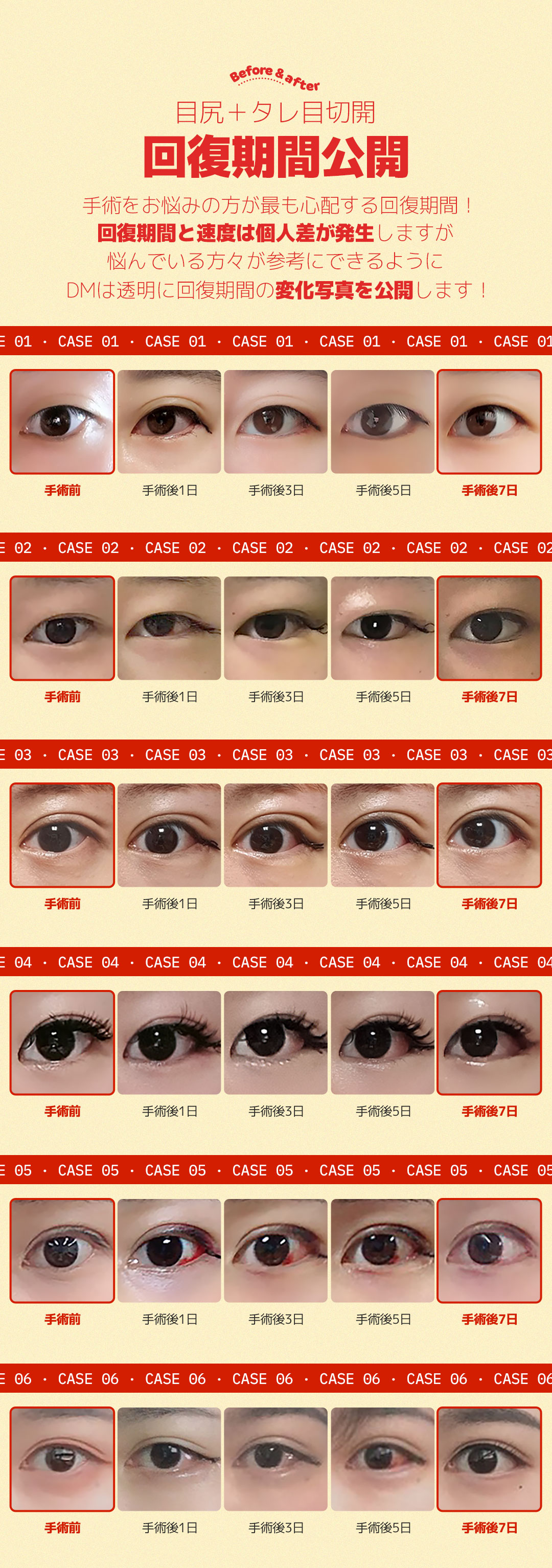 Cắt đuôi mắt tạo mắt cụp | Hướng tới tạo hình mắt tự nhiên | DM Thẩm mỹ Apgujeong Seoul