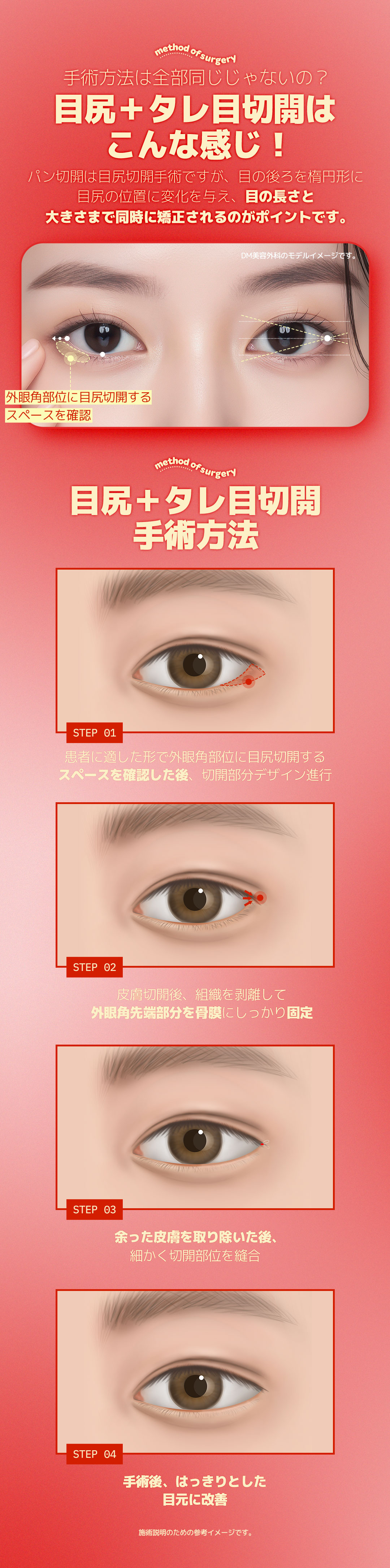 Cắt đuôi mắt tạo mắt cụp | Hướng tới tạo hình mắt tự nhiên | DM Thẩm mỹ Apgujeong Seoul