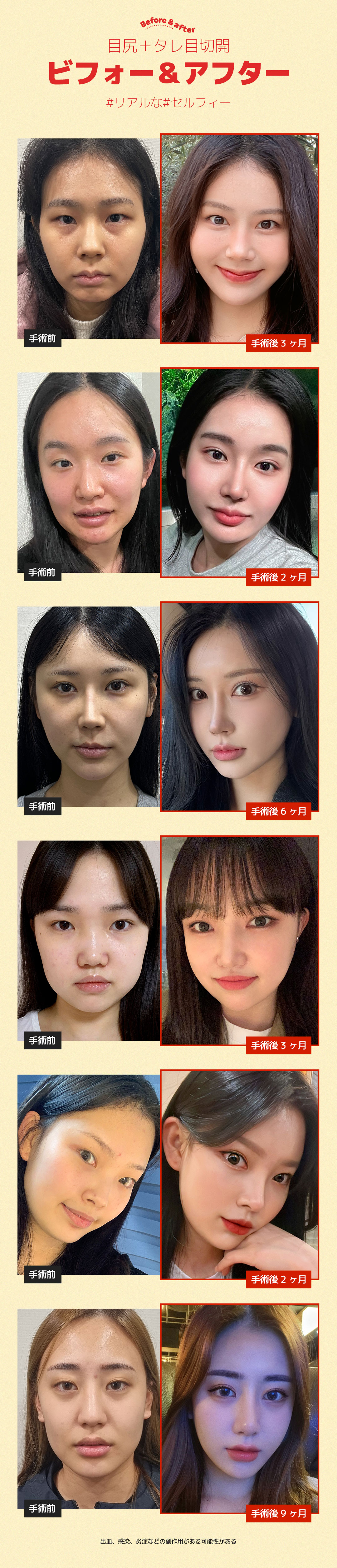 Cắt đuôi mắt tạo mắt cụp | Hướng tới tạo hình mắt tự nhiên | DM Thẩm mỹ Apgujeong Seoul