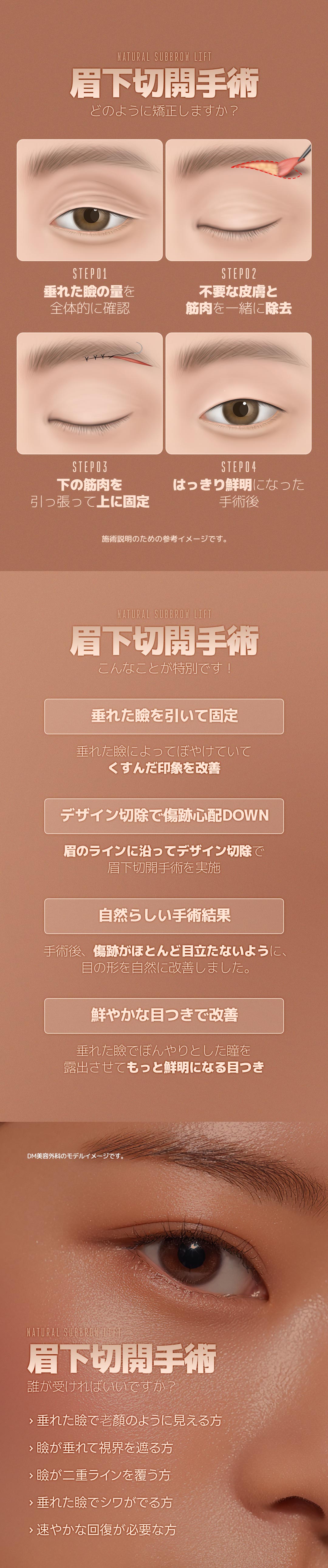 Phẫu thuật rạch dưới lông mày cải thiện chảy xệ mí mắt tự nhiên｜Phòng khám Thẩm mỹ Ngoại khoa DM (ga Apgujeong) Chỉnh hình vùng mắt Hàn Quốc