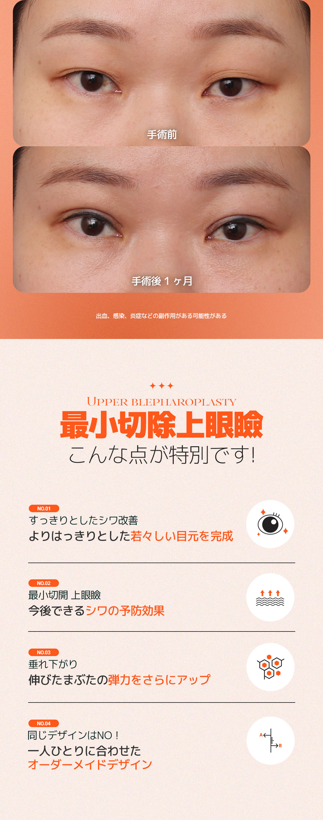 Phẫu thuật mí trên cắt vi mô DM Plastic Surgery Apgujeong Hàn Quốc｜Thủ thuật hướng tới cải thiện vùng mắt tự nhiên với rạch tối thiểu