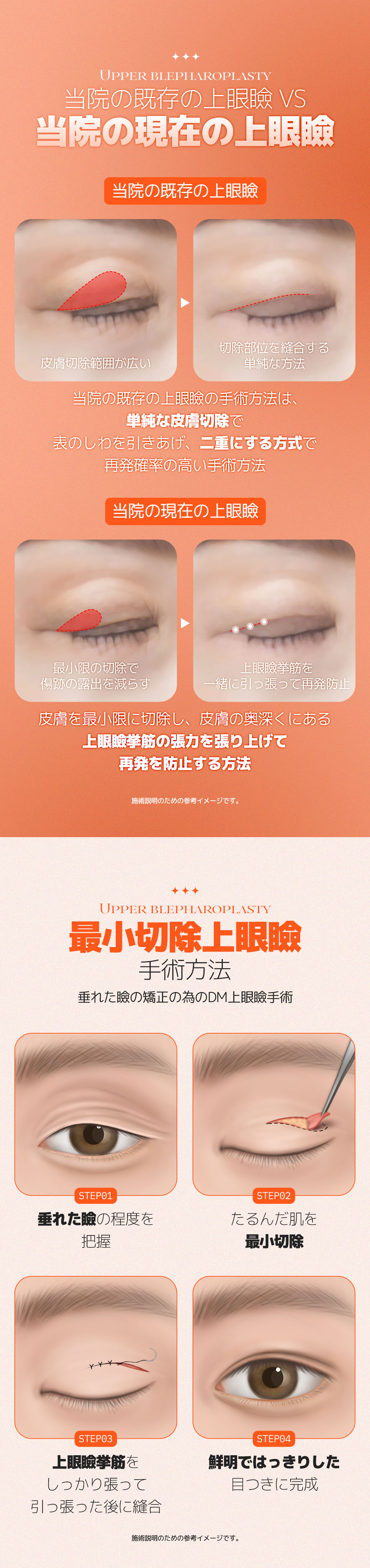 Phẫu thuật mí trên cắt vi mô DM Plastic Surgery Apgujeong Hàn Quốc｜Thủ thuật hướng tới cải thiện vùng mắt tự nhiên với rạch tối thiểu