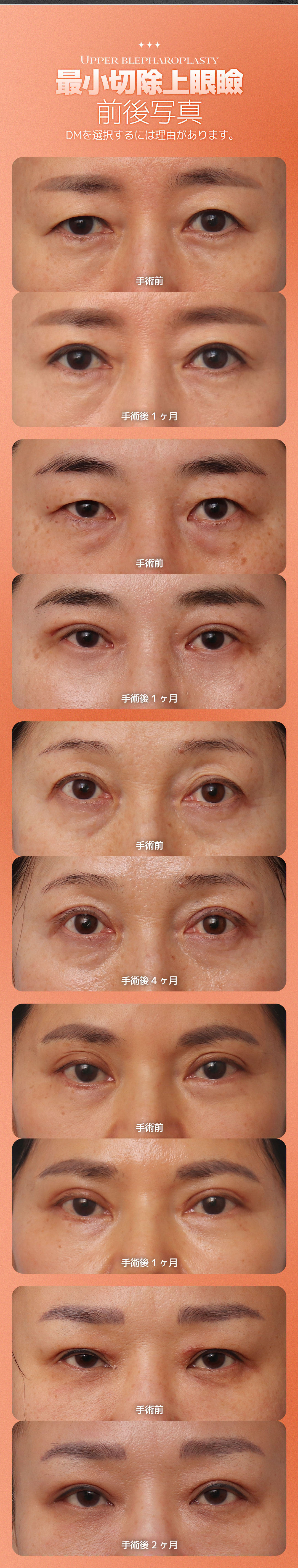 Phẫu thuật mí trên cắt vi mô DM Plastic Surgery Apgujeong Hàn Quốc｜Thủ thuật hướng tới cải thiện vùng mắt tự nhiên với rạch tối thiểu