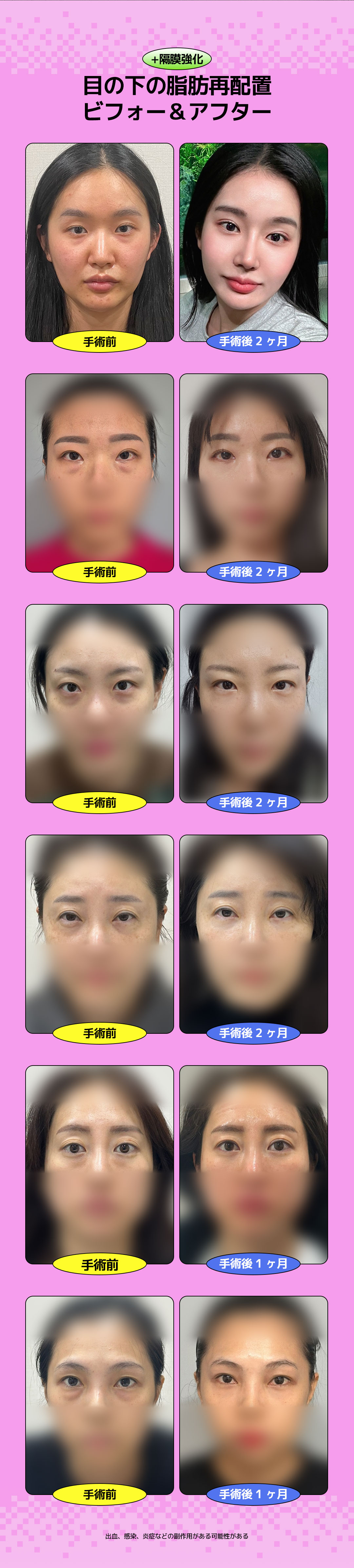 Tái định vị mỡ dưới mắt + Tăng cường vách ngăn cho đôi mắt sáng | DM Plastic Surgery giữ túi mắt | 3 phút đi bộ từ ga Apgujeong