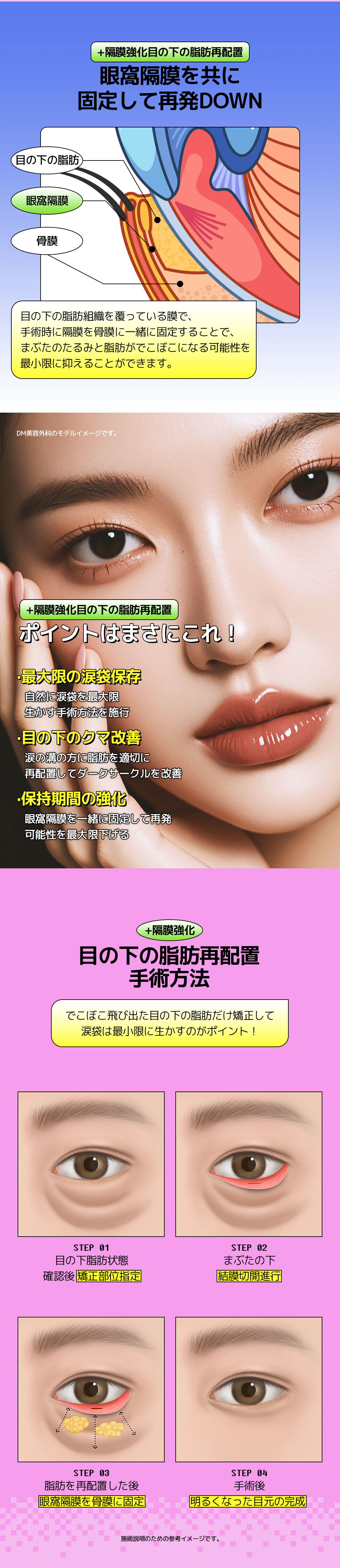 Tái định vị mỡ dưới mắt + Tăng cường vách ngăn cho đôi mắt sáng | DM Plastic Surgery giữ túi mắt | 3 phút đi bộ từ ga Apgujeong