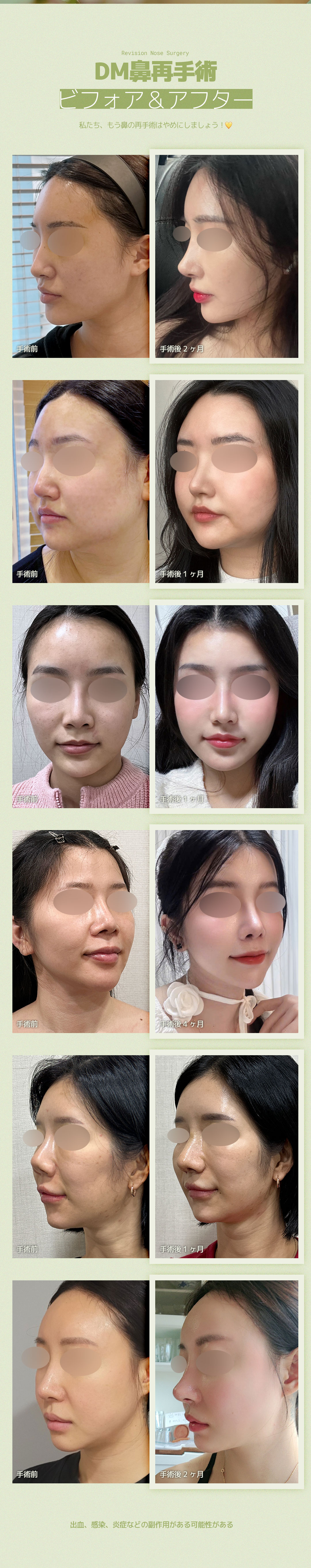 【Chuyên phẫu thuật lại mũi】DM Phẫu thuật Thẩm mỹ | Hướng tới mũi lý tưởng với phân tích chính xác 3D-CT | Cách ga Apgujeong 3 phút đi bộ