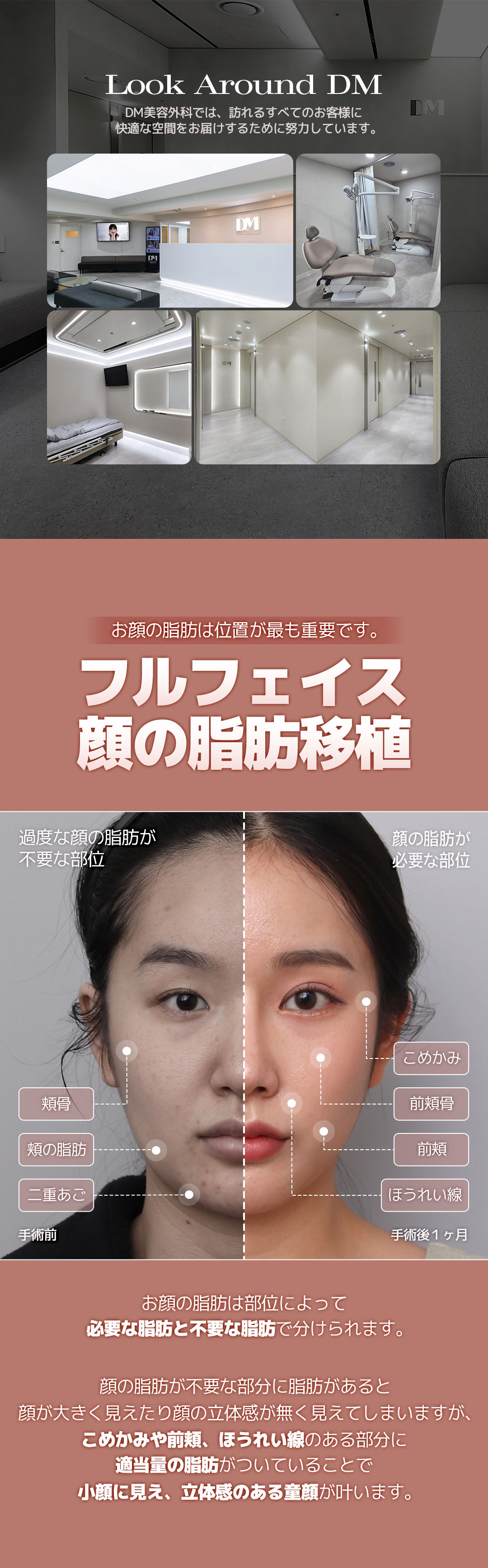 Ghép mỡ toàn mặt｜Tăng volume tự nhiên bằng mỡ tươi｜Seoul Apgujeong DM Plastic Surgery