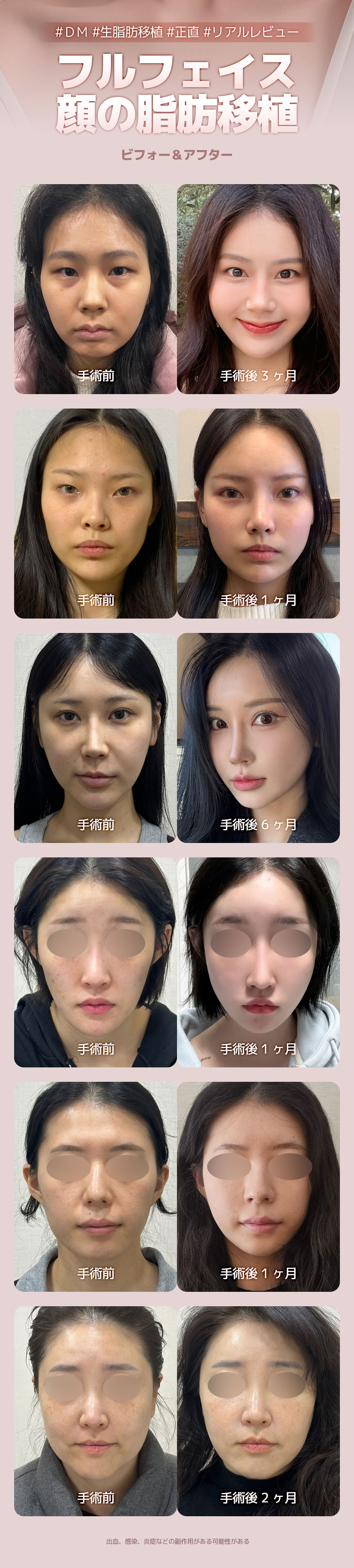 Ghép mỡ toàn mặt｜Tăng volume tự nhiên bằng mỡ tươi｜Seoul Apgujeong DM Plastic Surgery