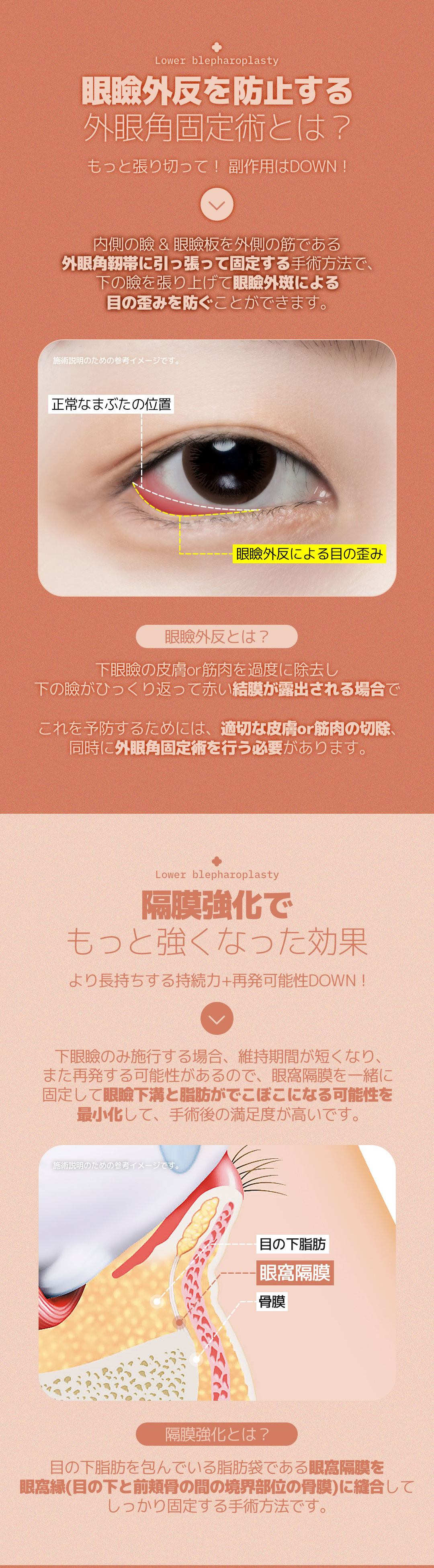 Hướng tới cải thiện chảy xệ・xỉn màu dưới mắt với Phẫu thuật mí dưới cố định góc mắt ngoài | Thẩm mỹ Hàn Quốc DM Thẩm mỹ Apgujeong