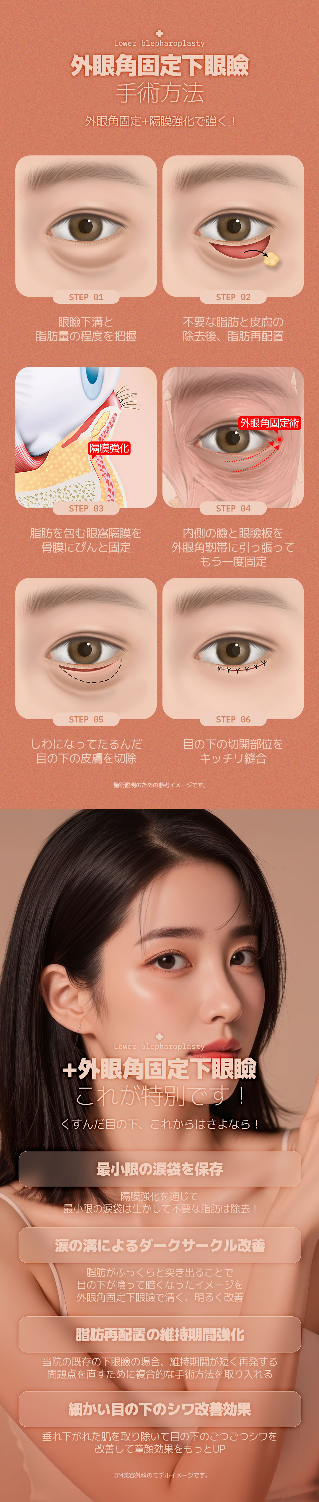 Hướng tới cải thiện chảy xệ・xỉn màu dưới mắt với Phẫu thuật mí dưới cố định góc mắt ngoài | Thẩm mỹ Hàn Quốc DM Thẩm mỹ Apgujeong