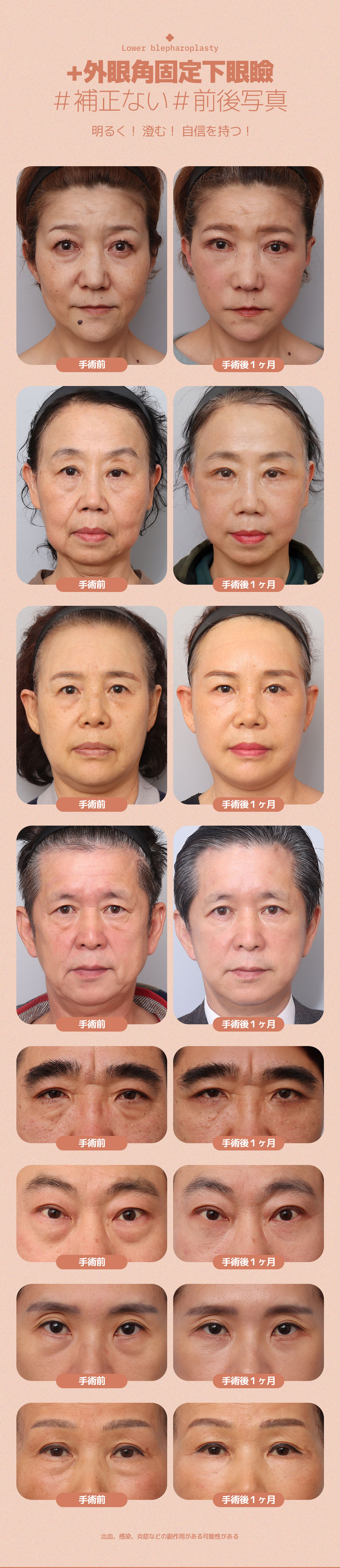 Hướng tới cải thiện chảy xệ・xỉn màu dưới mắt với Phẫu thuật mí dưới cố định góc mắt ngoài | Thẩm mỹ Hàn Quốc DM Thẩm mỹ Apgujeong