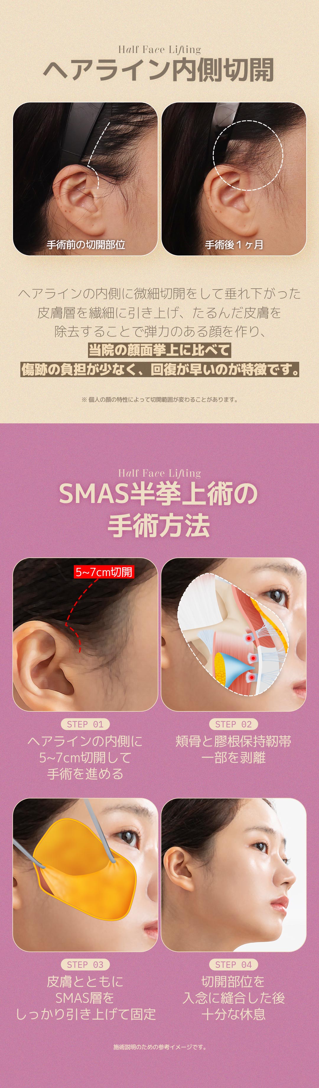 SMAS Semi Lift | Rạch bên trong đường chân tóc giảm sẹo căng da mặt | DM Clinic Apgujeong Seoul