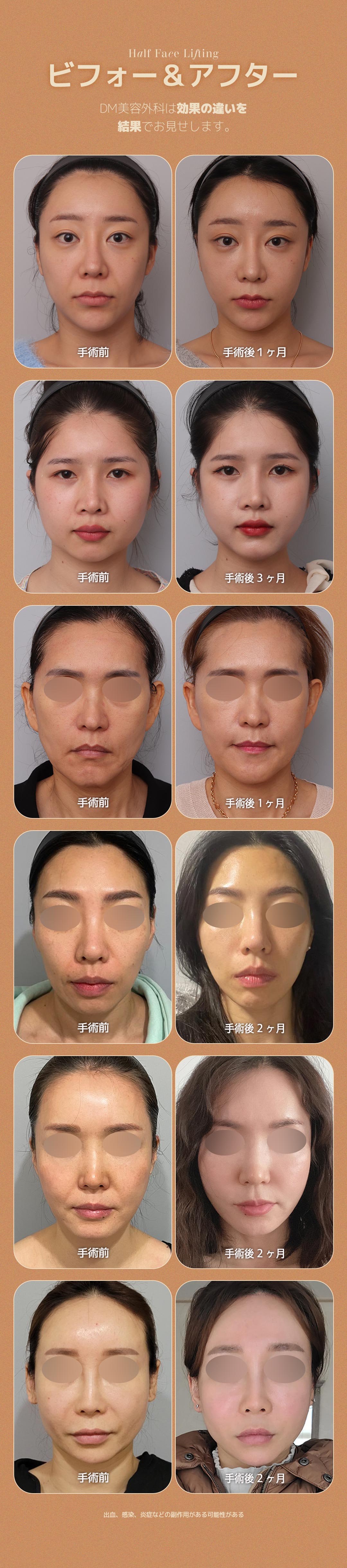SMAS Semi Lift | Rạch bên trong đường chân tóc giảm sẹo căng da mặt | DM Clinic Apgujeong Seoul