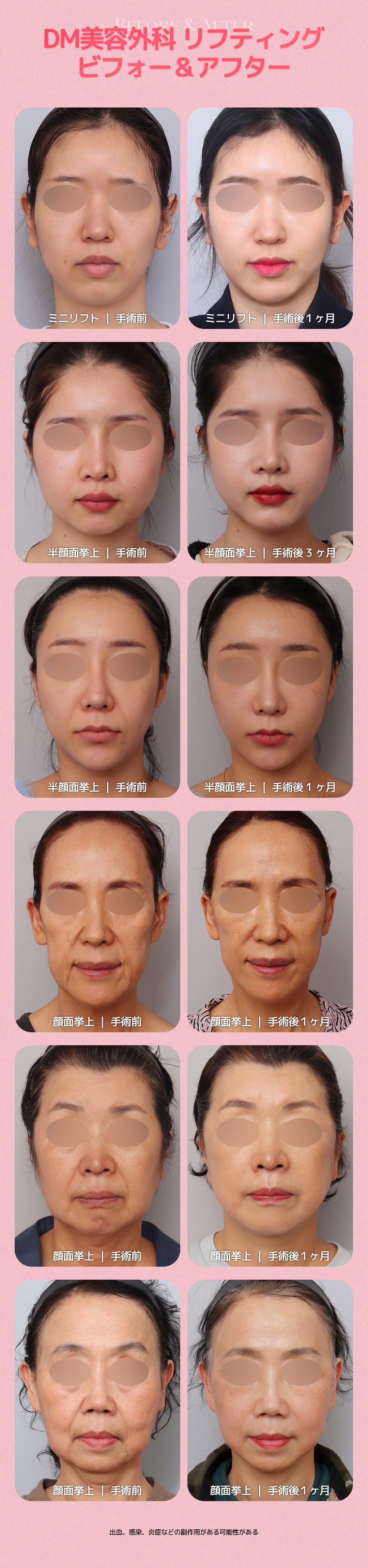 SMAS Mini Lift｜Viện trưởng đại diện trực tiếp thực hiện, nâng cơ giảm thiểu sẹo｜Viện thẩm mỹ DM