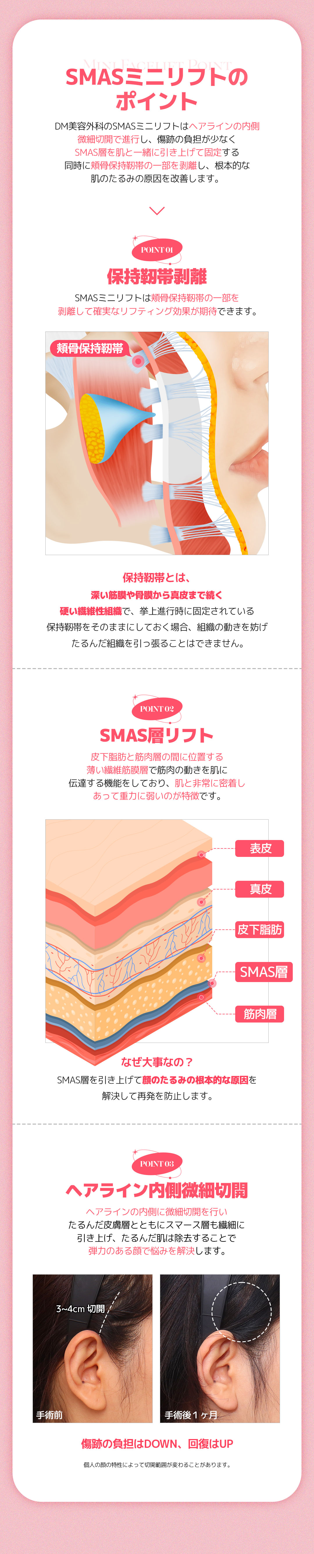 SMAS Mini Lift｜Viện trưởng đại diện trực tiếp thực hiện, nâng cơ giảm thiểu sẹo｜Viện thẩm mỹ DM