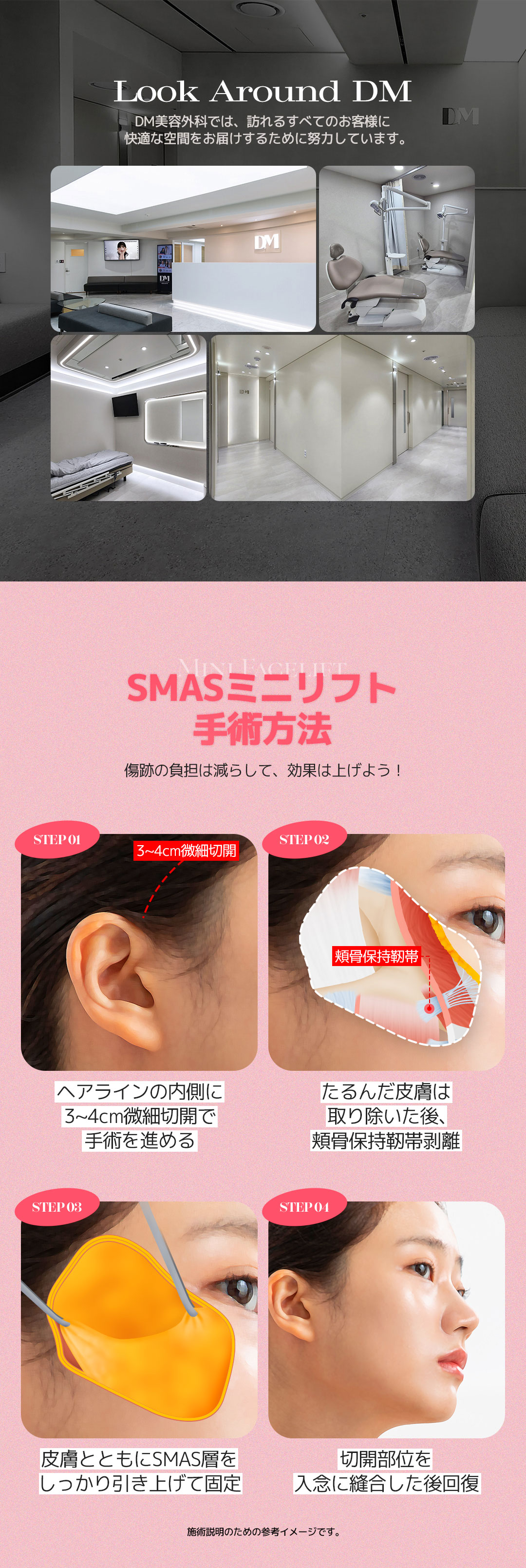 SMAS Mini Lift｜Viện trưởng đại diện trực tiếp thực hiện, nâng cơ giảm thiểu sẹo｜Viện thẩm mỹ DM