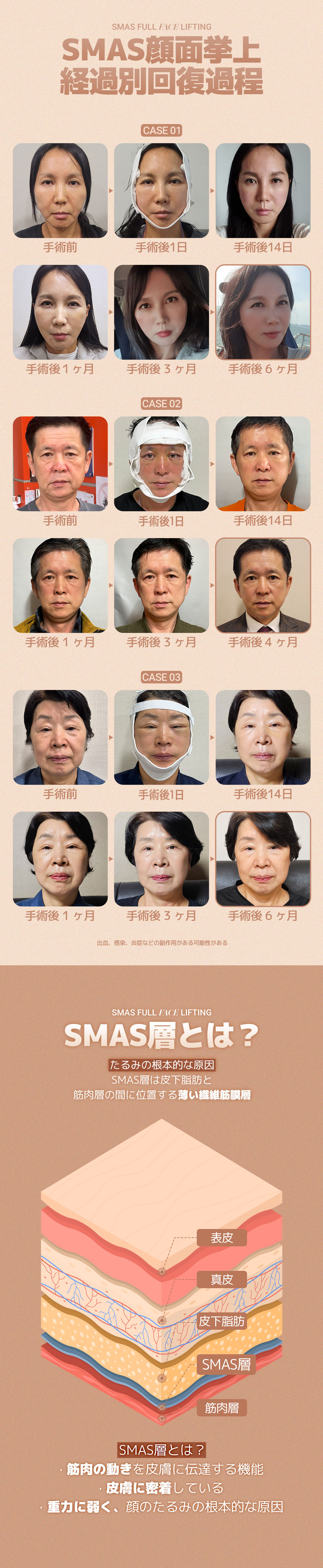 SMAS Face Lift | Phẫu thuật căng da mặt chính thống bởi bác sĩ chuyên khoa | DM Clinic (Apgujeong)