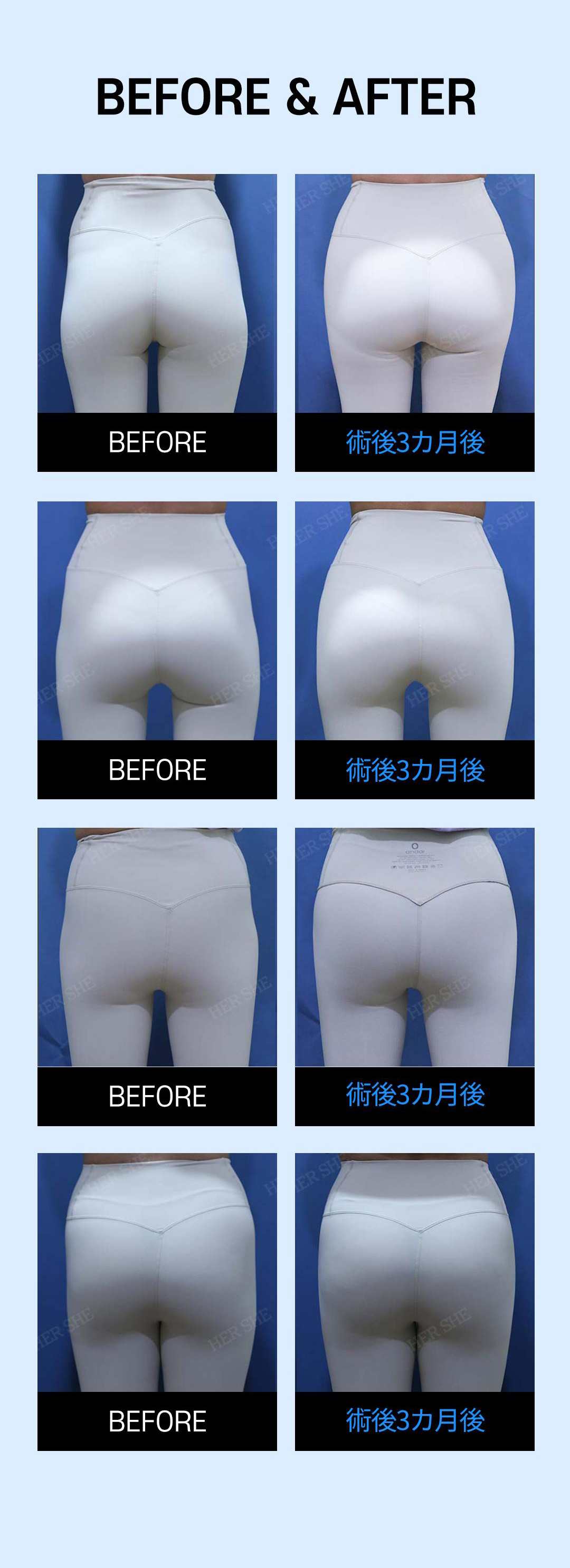 Thủ thuật filler xương chậu hướng đến đường cong cơ thể lý tưởng｜Phẫu thuật Thẩm mỹ HERSHE 30 năm thành tích｜Cheongdam