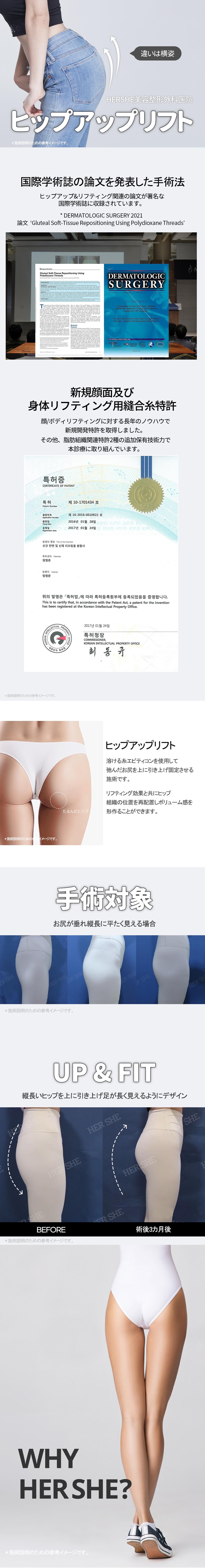 Hip Up Lift tại Viện thẩm mỹ HERSHE｜Hướng đến đường nét hông lý tưởng bằng chỉ tan｜Cheongdam Seoul