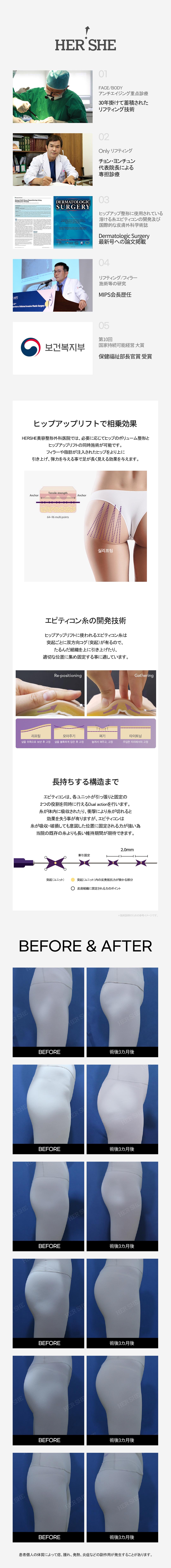 Hip Up Lift tại Viện thẩm mỹ HERSHE｜Hướng đến đường nét hông lý tưởng bằng chỉ tan｜Cheongdam Seoul