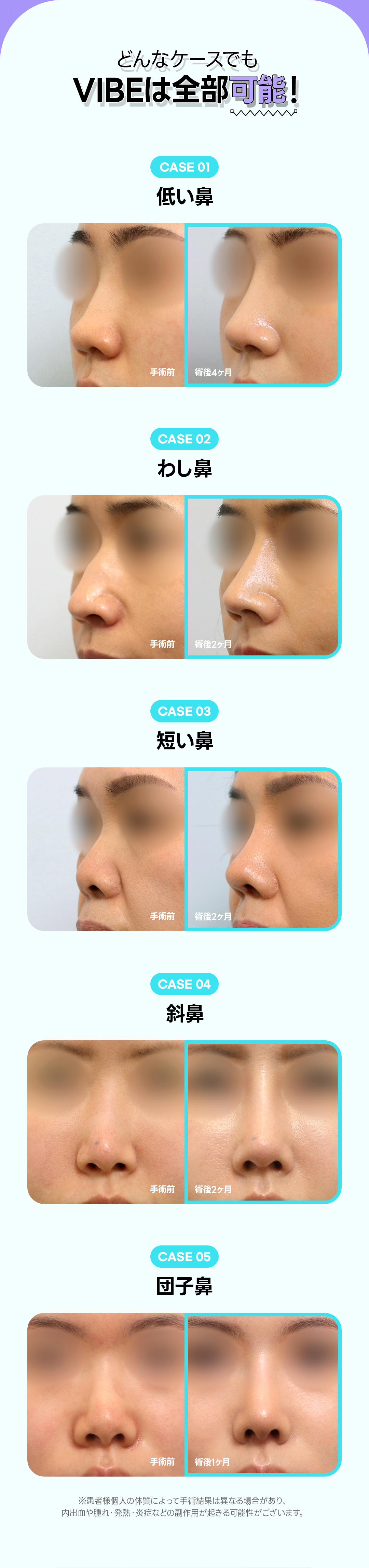 【Nâng mũi Hàn Quốc】Vibe Phẫu thuật Thẩm mỹ | Lần đầu từ 2.990.000 won~ Hướng tới đường nét mũi lý tưởng với chẩn đoán chính xác 3D-CT | Kết nối trực tiếp ga Sinnonhyeon