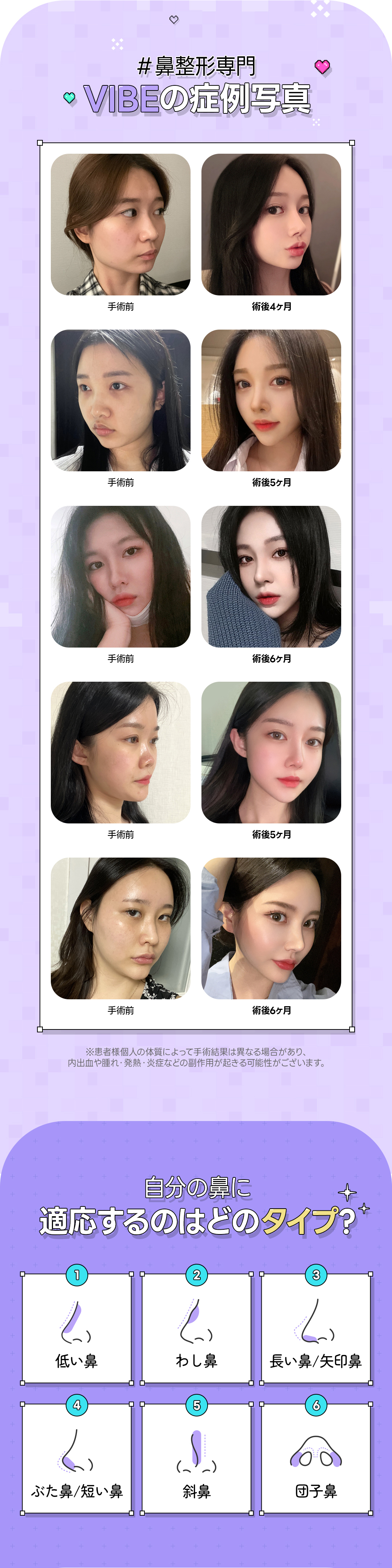 【Nâng mũi Hàn Quốc】Vibe Phẫu thuật Thẩm mỹ | Lần đầu từ 2.990.000 won~ Hướng tới đường nét mũi lý tưởng với chẩn đoán chính xác 3D-CT | Kết nối trực tiếp ga Sinnonhyeon