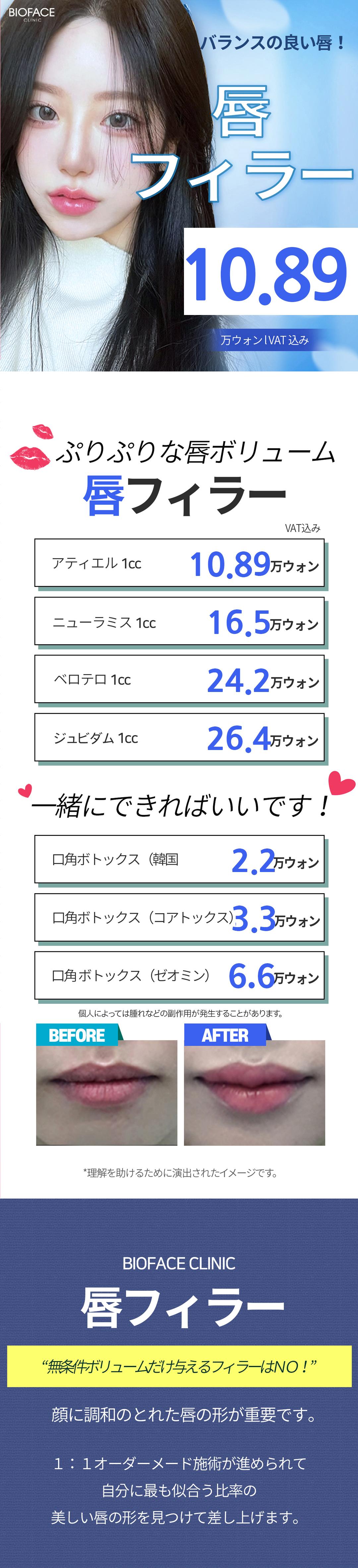 Hướng đến đôi môi căng mọng quyến rũ với filler môi | Điều trị tùy chỉnh 1:1 | Bioface Phòng khám Seoul ga Gangnam