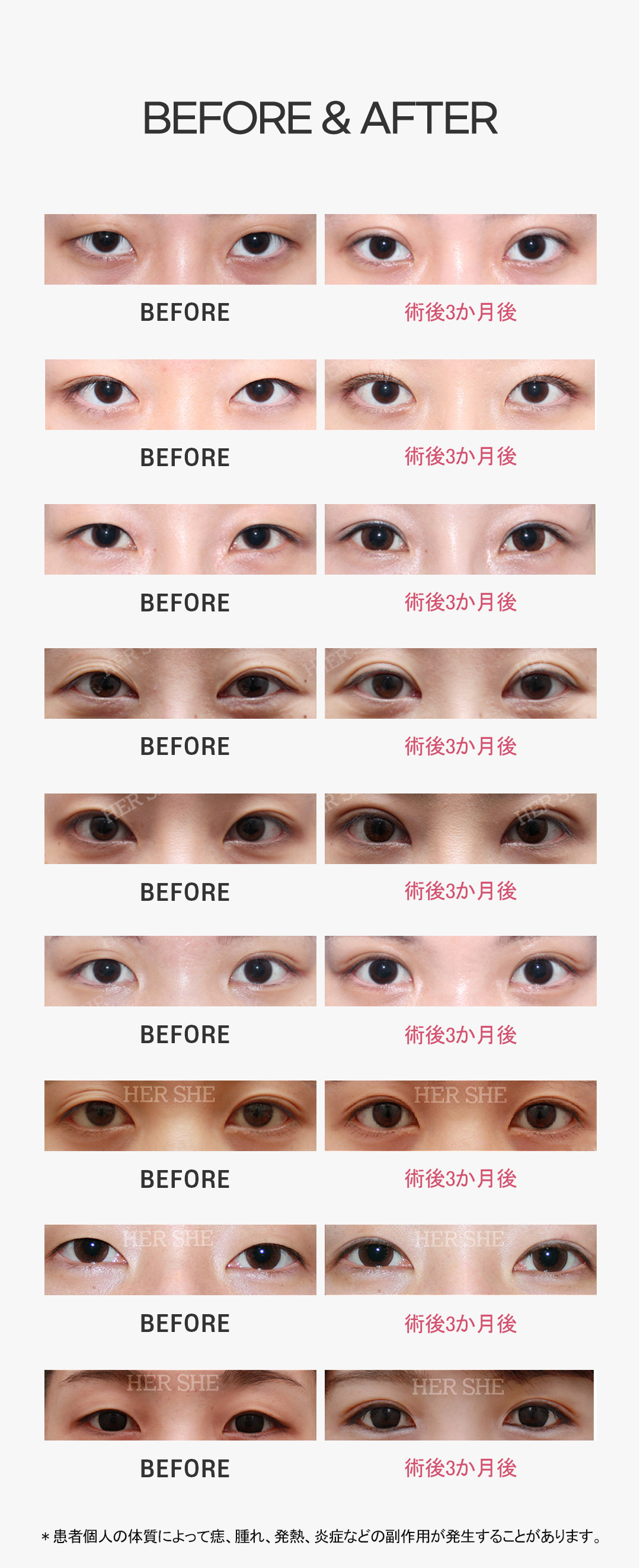 Tạo mí đôi bấm mí | Hướng tới mí đôi tròn xoe tự nhiên | Phòng khám HERSHE Thẩm mỹ (ga Cheongdam)