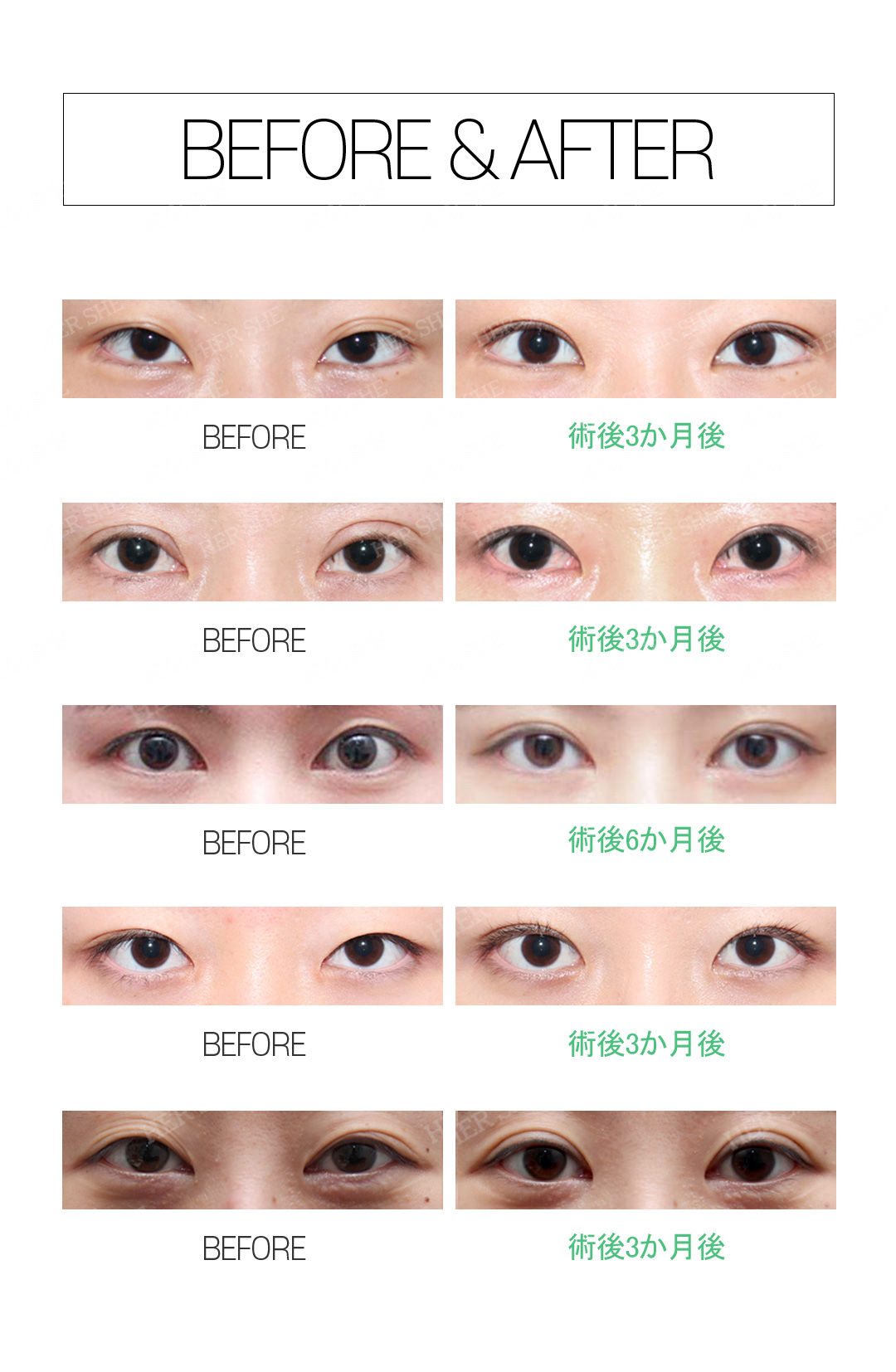 Phẫu thuật lại cắt mí đôi | Thủ thuật đặt hàng riêng cá nhân bởi bác sĩ chuyên khoa tốt nghiệp ĐH Yonsei | HERSHE Thẩm mỹ