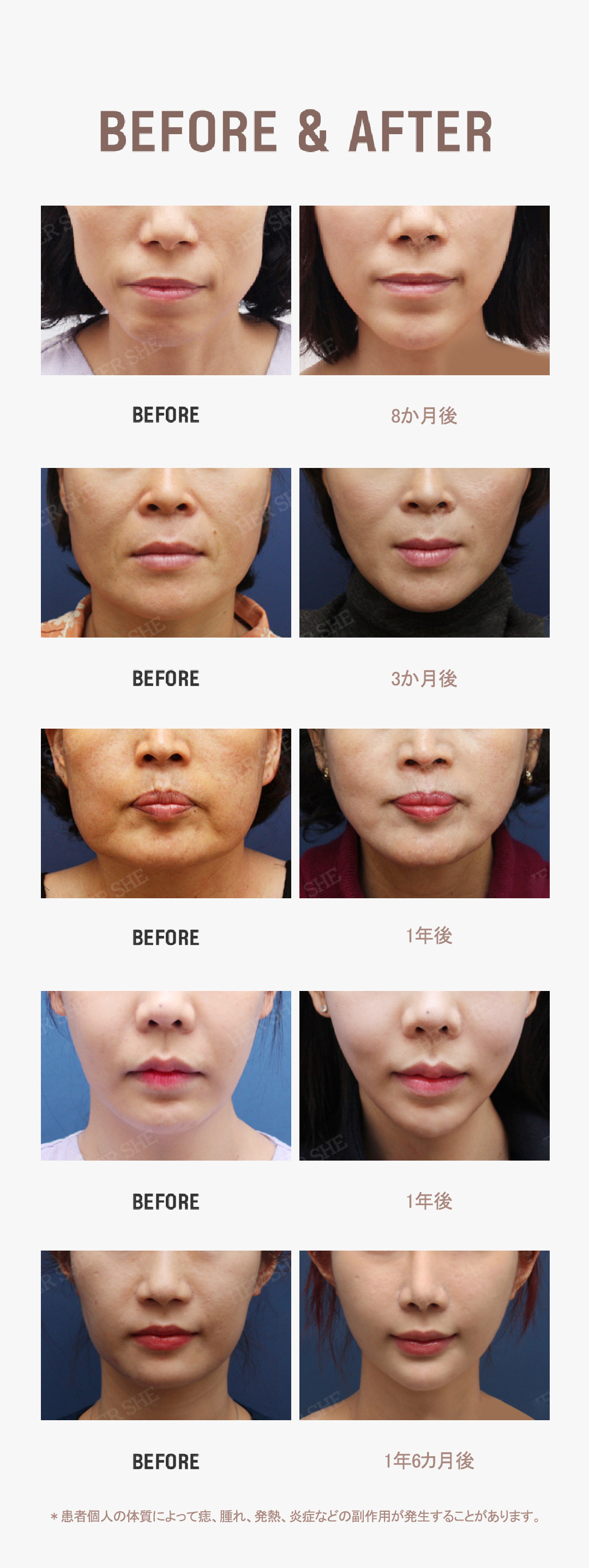 Chỉ nâng Epiticon | Liệu trình nâng mid-face và mặt nhỏ bởi bác sĩ phát triển | HERSHE Thẩm mỹ Ngoại khoa Seoul Cheongdam